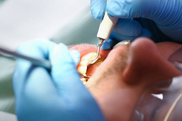 Best Emergency Tooth Extraction in Linden, MI